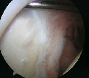 Arthroscopy Normal Cartilage under Biceps Labrum